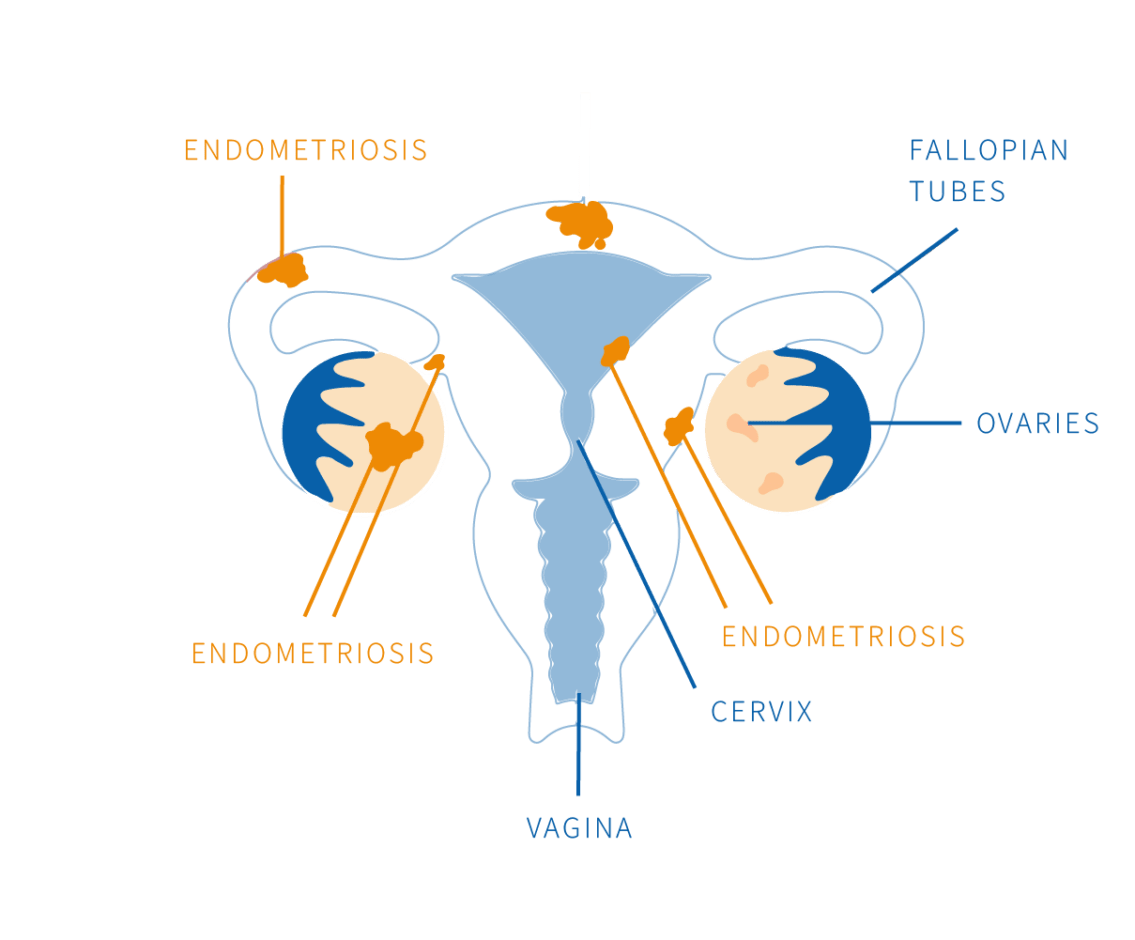 Endometriosis And Immunity Micro Immunotherapy 7976