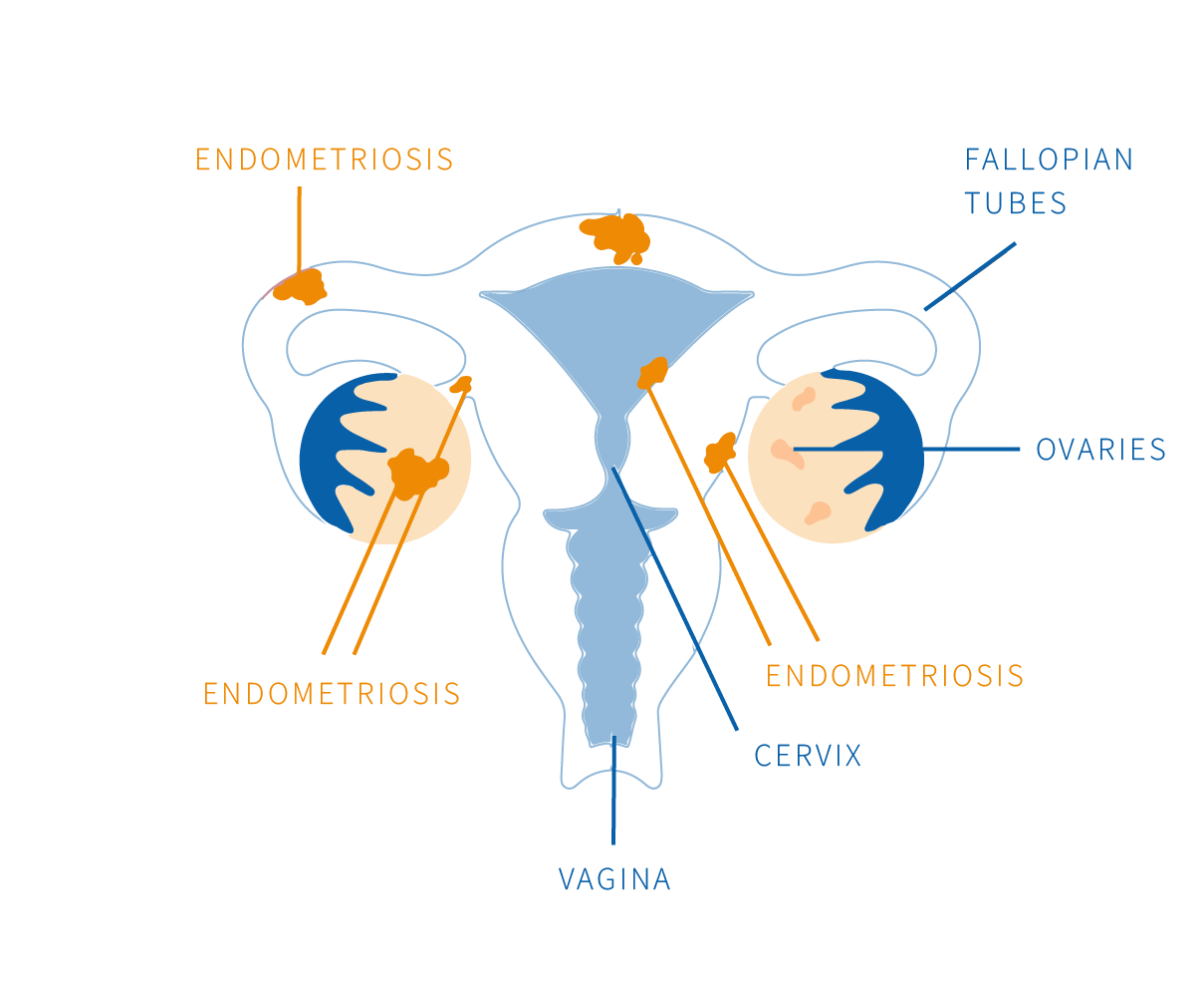 endometriosis research paper